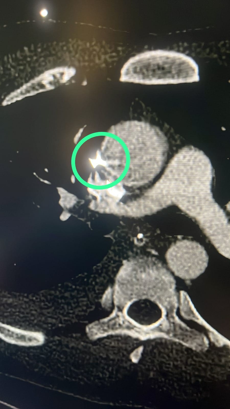 The fragment that settled close to the aorta