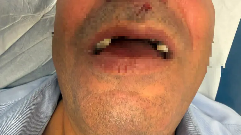 Bus driver assaulted in Jerusalem: 'I was beaten and lost consciousness'