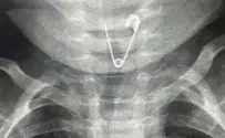The surgery that saved the toddler who swallowed a safety pin