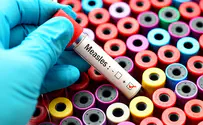 Israel's measles outbreak started in Ukraine