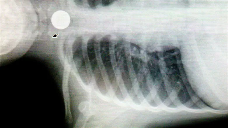 Button battery lodged in child's throat (illustrative)